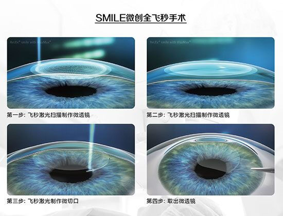 蔡司全飛秒、蔡司半飛秒近視手術(shù)與蔡司全飛秒flex手術(shù)