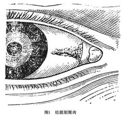 黑眼睛前面多長出一塊白肉怎么辦？
