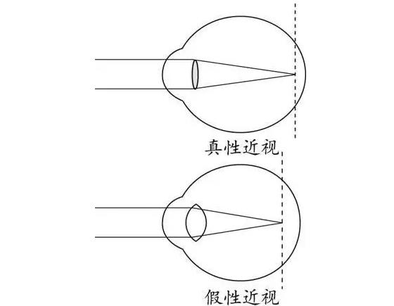 關(guān)于青少年近視的三個(gè)“小姿勢(shì)”